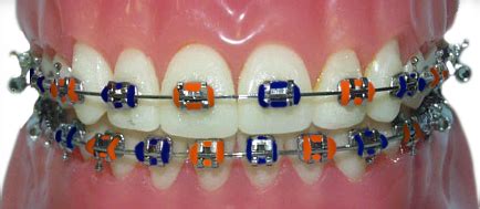 braces auburndale|Auburn Orthodontist .